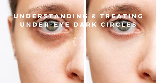 Understanding & Treating Under-Eye Dark Circles