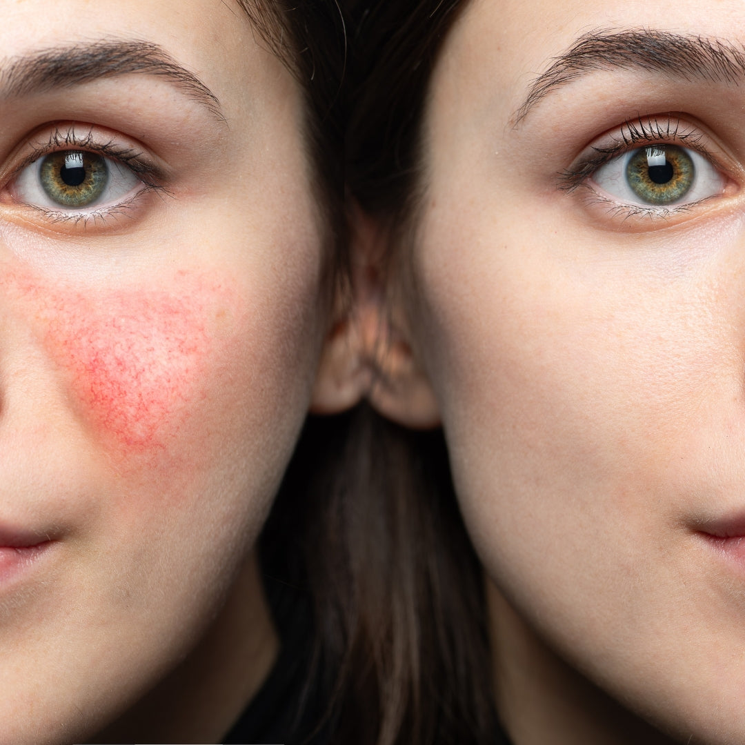 ROSACEA